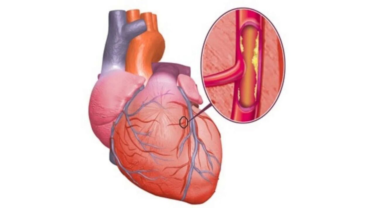 Problemi cardiaci dovuti alla pressione alta